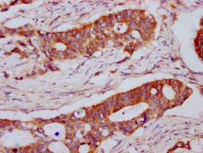 LPL / Lipoprotein Lipase Antibody - Immunohistochemistry Dilution at 1:800 and staining in paraffin-embedded human colon cancer performed on a Leica BondTM system. After dewaxing and hydration, antigen retrieval was mediated by high pressure in a citrate buffer (pH 6.0). Section was blocked with 10% normal Goat serum 30min at RT. Then primary antibody (1% BSA) was incubated at 4°C overnight. The primary is detected by a biotinylated Secondary antibody and visualized using an HRP conjugated SP system.