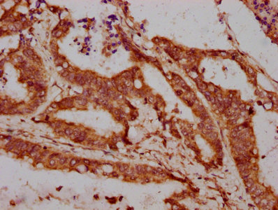 LPO / Lactoperoxidase Antibody - Immunohistochemistry Dilution at 1:300 and staining in paraffin-embedded human colon cancer performed on a Leica BondTM system. After dewaxing and hydration, antigen retrieval was mediated by high pressure in a citrate buffer (pH 6.0). Section was blocked with 10% normal Goat serum 30min at RT. Then primary antibody (1% BSA) was incubated at 4°C overnight. The primary is detected by a biotinylated Secondary antibody and visualized using an HRP conjugated SP system.