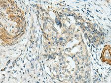LPPR5 Antibody - Immunohistochemistry of paraffin-embedded Human cervical cancer tissue  using PLPPR5 Polyclonal Antibody at dilution of 1:120(×200)