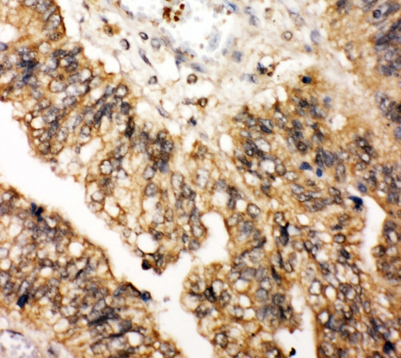LPXN / Leupaxin Antibody - IHC analysis of Leupaxin using anti-Leupaxin antibody. Leupaxin was detected in paraffin-embedded section of human intestinal cancer tissue. Heat mediated antigen retrieval was performed in citrate buffer (pH6, epitope retrieval solution) for 20 mins. The tissue section was blocked with 10% goat serum. The tissue section was then incubated with 1µg/ml rabbit anti-Leupaxin antibody overnight at 4°C. Biotinylated goat anti-rabbit IgG was used as secondary antibody and incubated for 30 minutes at 37°C. The tissue section was developed using Strepavidin-Biotin-Complex (SABC) with DAB as the chromogen.