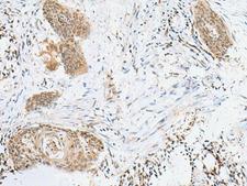 LPXN / Leupaxin Antibody - Immunohistochemistry of paraffin-embedded Human esophagus cancer tissue  using LPXN Polyclonal Antibody at dilution of 1:60(×200)