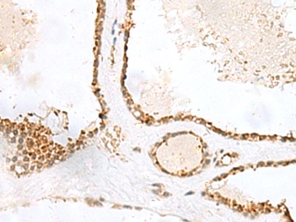 LPXN / Leupaxin Antibody - Immunohistochemistry of paraffin-embedded Human thyroid cancer tissue  using LPXN Polyclonal Antibody at dilution of 1:60(×200)