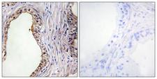 LRAT Antibody - Peptide - + Immunohistochemistry analysis of paraffin-embedded human prostate carcinoma tissue using LRAT antibody.