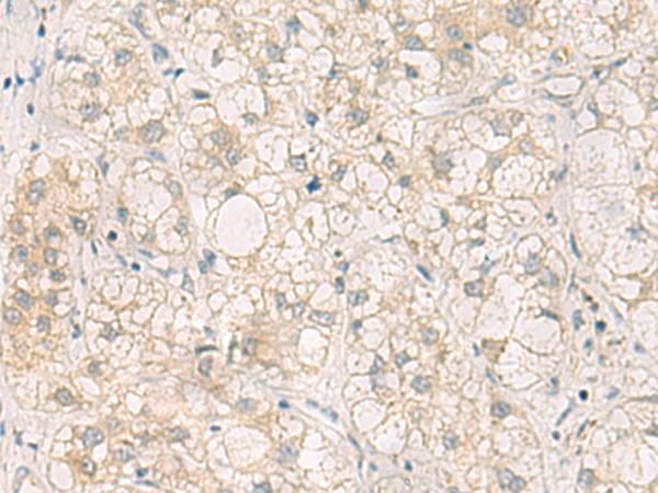 LRAT Antibody - Immunohistochemistry of paraffin-embedded Human liver cancer tissue  using LRAT Polyclonal Antibody at dilution of 1:50(×200)