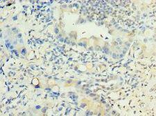 LRG1 / LRG Antibody - Immunohistochemistry of paraffin-embedded human lung cancer using antibody at 1:100 dilution.