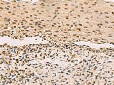 LRIF1 / RIF1 Antibody - Immunohistochemistry of paraffin-embedded Human cervical cancer tissue  using LRIF1 Polyclonal Antibody at dilution of 1:70(×200)