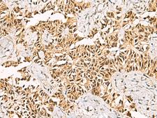 LRIF1 / RIF1 Antibody - Immunohistochemistry of paraffin-embedded Human ovarian cancer tissue  using LRIF1 Polyclonal Antibody at dilution of 1:70(×200)