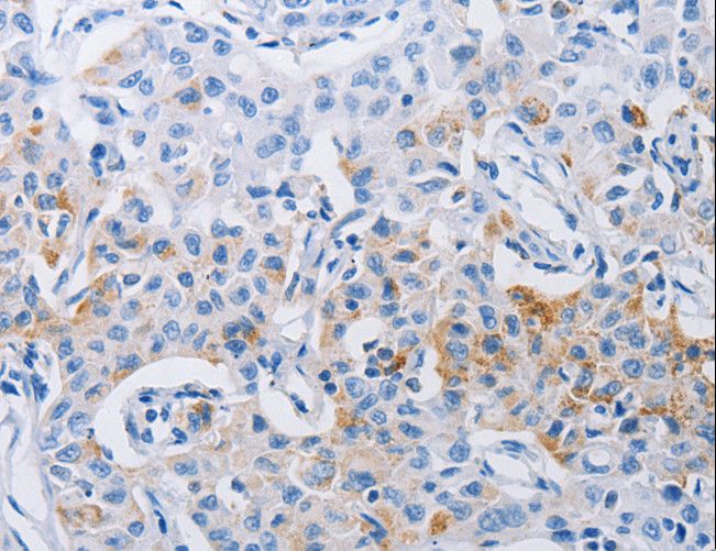 LRIG1 Antibody - Immunohistochemistry of paraffin-embedded Human lung cancer using LRIG1 Polyclonal Antibody at dilution of 1:120.