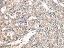 LRP1B Antibody - Immunohistochemistry of paraffin-embedded Human liver cancer tissue  using LRP1B Polyclonal Antibody at dilution of 1:50(×200)