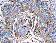 LRP2 / Megalin Antibody - Immunohistochemistry of paraffin-embedded Human esophagus cancer using LRP2 Polyclonal Antibody at dilution of 1:40.