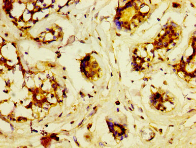 LRP2 / Megalin Antibody - Immunohistochemistry image at a dilution of 1:600 and staining in paraffin-embedded human breast cancer performed on a Leica BondTM system. After dewaxing and hydration, antigen retrieval was mediated by high pressure in a citrate buffer (pH 6.0) . Section was blocked with 10% normal goat serum 30min at RT. Then primary antibody (1% BSA) was incubated at 4 °C overnight. The primary is detected by a biotinylated secondary antibody and visualized using an HRP conjugated SP system.