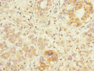LRP4 Antibody - Immunohistochemistry of paraffin-embedded human pancreatic cancer at dilution 1:100