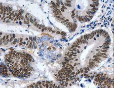 LRP5 Antibody - Immunohistochemistry of paraffin-embedded Human ovarian cancer using LRP5 Polyclonal Antibody at dilution of 1:55.