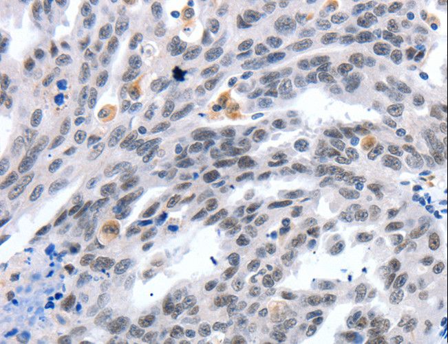 LRP5 Antibody - Immunohistochemistry of paraffin-embedded Human ovarian cancer using LRP5 Polyclonal Antibody at dilution of 1:55.