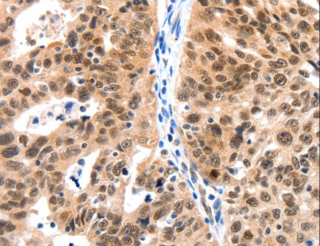 LRP5 Antibody - Immunohistochemistry of paraffin-embedded Human ovarian cancer using LRP5 Polyclonal Antibody at dilution of 1:115.