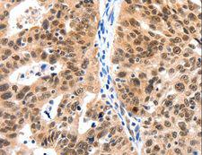 LRP5 Antibody - Immunohistochemistry of paraffin-embedded Human ovarian cancer using LRP5 Polyclonal Antibody at dilution of 1:115.