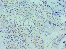 LRP6 Antibody - Immunohistochemistry of paraffin-embedded human breast cancer using antibody at 1:100 dilution.