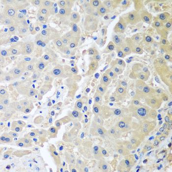 LRP6 Antibody - Immunohistochemistry of paraffin-embedded human gastric cancer using LRP6 antibody at dilution of 1:100 (40x lens).