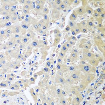 LRP6 Antibody - Immunohistochemistry of paraffin-embedded Human gastric cancer using LRP6 Polyclonal Antibody at dilution of 1:100 (40x lens).