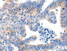 LRPAP1 Antibody - Immunohistochemistry of paraffin-embedded Human colon cancer using LRPAP1 Polyclonal Antibody at dilution of 1:100.