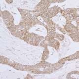 LRPPRC Antibody - Detection of human LRPPRC by immunohistochemistry. Sample: FFPE section of human ovarian carcinoma. Antibody: Affinity purified rabbit anti- LRPPRC used at a dilution of 1:1,000 (1µg/ml). Detection: DAB