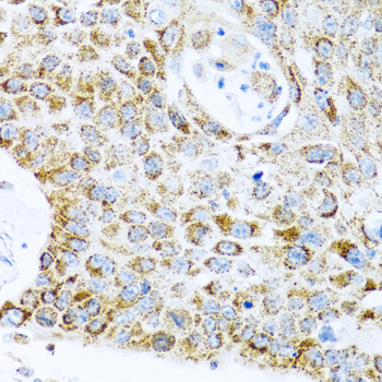 LRPPRC Antibody - Immunohistochemistry of paraffin-embedded human lung cancer tissue.
