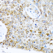 LRPPRC Antibody - Immunohistochemistry of paraffin-embedded human lung cancer tissue.