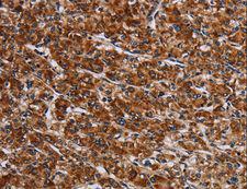 LRRC15 Antibody - Immunohistochemistry of paraffin-embedded Human cervical cancer using LRRC15 Polyclonal Antibody at dilution of 1:60.