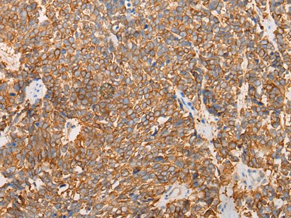 LRRC16 / CARMIL Antibody - Immunohistochemistry of paraffin-embedded Human lung cancer tissue  using LRRC16A Polyclonal Antibody at dilution of 1:40(×200)
