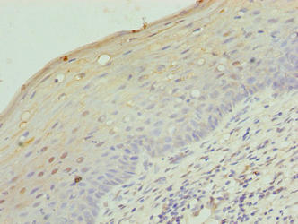 LRRC18 Antibody - Immunohistochemistry of paraffin-embedded human cervical cancer using LRRC18 Antibody at dilution of 1:100