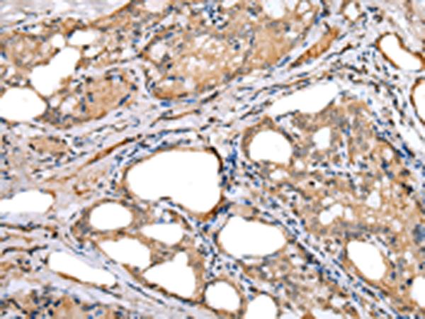 LRRC19 Antibody - Immunohistochemistry of paraffin-embedded Human thyroid cancer tissue  using LRRC19 Polyclonal Antibody at dilution of 1:30(×200)
