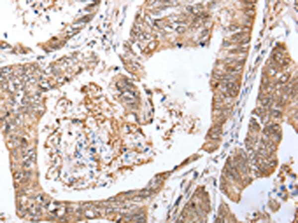 LRRC19 Antibody - Immunohistochemistry of paraffin-embedded Human colorectal cancer tissue  using LRRC19 Polyclonal Antibody at dilution of 1:30(×200)