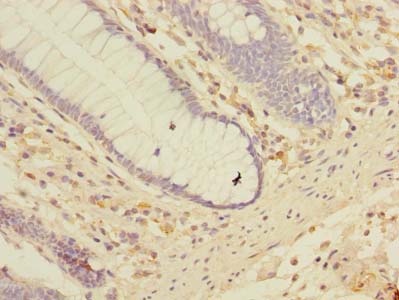 LRRC2 Antibody - Immunohistochemistry of paraffin-embedded human colon cancer using antibody at dilution of 1:100.