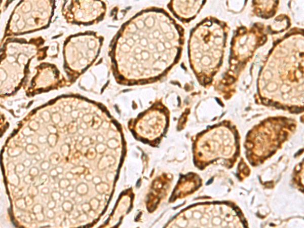 LRRC2 Antibody - Immunohistochemistry of paraffin-embedded Human thyroid cancer tissue  using LRRC2 Polyclonal Antibody at dilution of 1:55(×200)