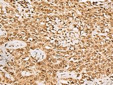 LRRC2 Antibody - Immunohistochemistry of paraffin-embedded Human ovarian cancer tissue  using LRRC2 Polyclonal Antibody at dilution of 1:70(×200)