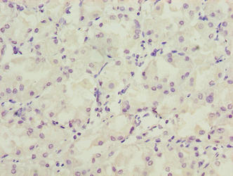 LRRC20 Antibody - Immunohistochemistry of paraffin-embedded human gastric cancer using LRRC20 Antibody at dilution of 1:100