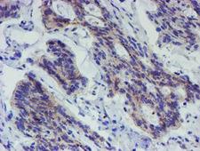 LRRC25 Antibody - IHC of paraffin-embedded Carcinoma of Human pancreas tissue using anti-LRRC25 mouse monoclonal antibody.