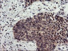 LRRC25 Antibody - IHC of paraffin-embedded Carcinoma of Human lung tissue using anti-LRRC25 mouse monoclonal antibody.