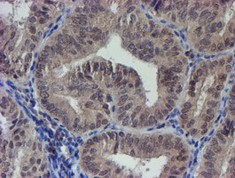 LRRC25 Antibody - IHC of paraffin-embedded Adenocarcinoma of Human endometrium tissue using anti-LRRC25 mouse monoclonal antibody.