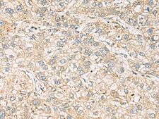 LRRC28 Antibody - Immunohistochemistry of paraffin-embedded Human liver cancer tissue  using LRRC28 Polyclonal Antibody at dilution of 1:60(×200)