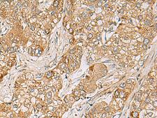 LRRC28 Antibody - Immunohistochemistry of paraffin-embedded Human liver cancer tissue  using LRRC28 Polyclonal Antibody at dilution of 1:80(×200)