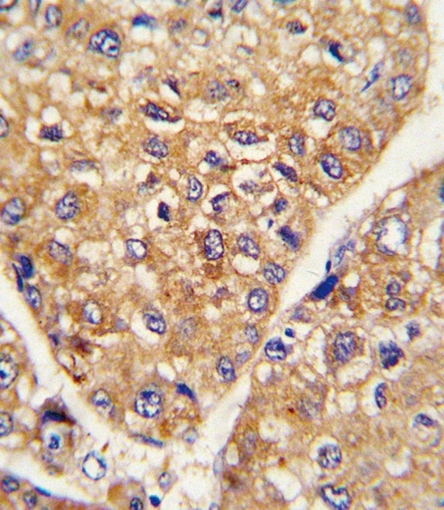 LRRC32 Antibody - Formalin-fixed and paraffin-embedded human hepatocarcinoma reacted with GARP Antibody , which was peroxidase-conjugated to the secondary antibody, followed by DAB staining. This data demonstrates the use of this antibody for immunohistochemistry; clinical relevance has not been evaluated.