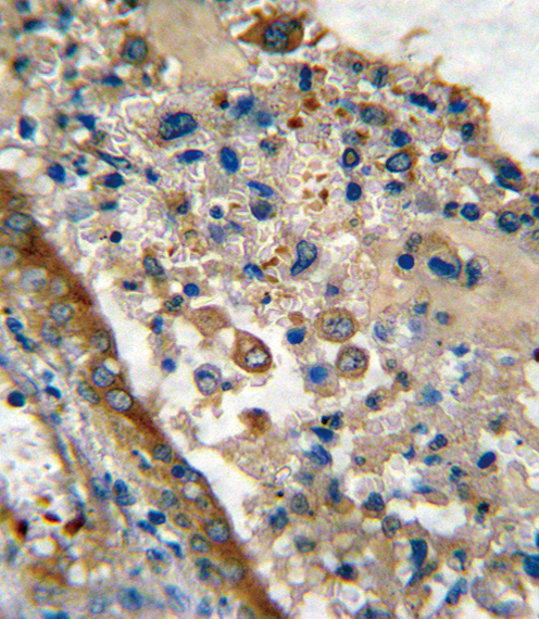 LRRC32 Antibody - Formalin-fixed and paraffin-embedded human lung carcinoma reacted with GARP Antibody , which was peroxidase-conjugated to the secondary antibody, followed by DAB staining. This data demonstrates the use of this antibody for immunohistochemistry; clinical relevance has not been evaluated.