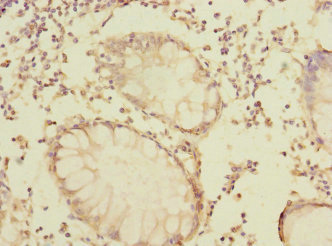 LRRC32 Antibody - Immunohistochemistry of paraffin-embedded human colon cancer using LRRC32 Antibody at dilution of 1:100