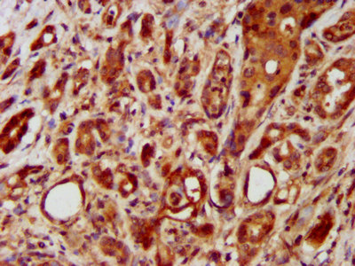 LRRC45 Antibody - Immunohistochemistry image at a dilution of 1:400 and staining in paraffin-embedded human pancreatic cancer performed on a Leica BondTM system. After dewaxing and hydration, antigen retrieval was mediated by high pressure in a citrate buffer (pH 6.0) . Section was blocked with 10% normal goat serum 30min at RT. Then primary antibody (1% BSA) was incubated at 4 °C overnight. The primary is detected by a biotinylated secondary antibody and visualized using an HRP conjugated SP system.