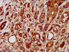 LRRC45 Antibody - Immunohistochemistry image at a dilution of 1:400 and staining in paraffin-embedded human pancreatic cancer performed on a Leica BondTM system. After dewaxing and hydration, antigen retrieval was mediated by high pressure in a citrate buffer (pH 6.0) . Section was blocked with 10% normal goat serum 30min at RT. Then primary antibody (1% BSA) was incubated at 4 °C overnight. The primary is detected by a biotinylated secondary antibody and visualized using an HRP conjugated SP system.