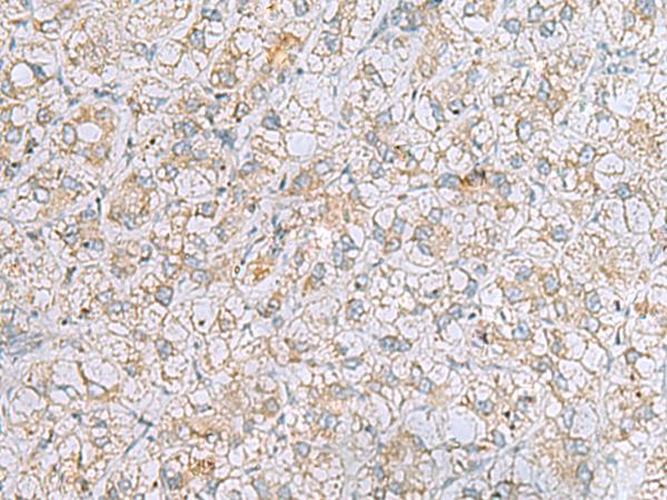 LRRC49 Antibody - Immunohistochemistry of paraffin-embedded Human liver cancer tissue  using LRRC49 Polyclonal Antibody at dilution of 1:40(×200)