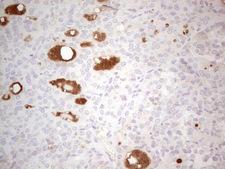 LRRC6 Antibody - Immunohistochemical staining of paraffin-embedded Carcinoma of Human thyroid tissue using anti-LRRC6 mouse monoclonal antibody. (Heat-induced epitope retrieval by 1 mM EDTA in 10mM Tris, pH8.5, 120C for 3min,