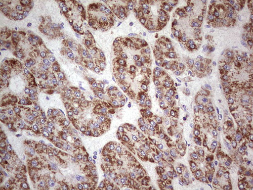 LRRC6 Antibody - Immunohistochemical staining of paraffin-embedded Carcinoma of Human liver tissue using anti-LRRC6 mouse monoclonal antibody.  Dilution: 1:150