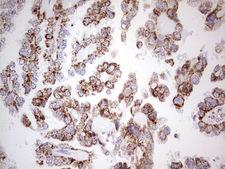 LRRC6 Antibody - Immunohistochemical staining of paraffin-embedded Adenocarcinoma of Human ovary tissue using anti-LRRC6 mouse monoclonal antibody.  Dilution: 1:150